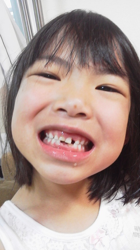14 歯抜けたァ～